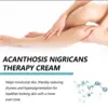 EELHOE Acanthosis Nigricans Therapy Cream Neck Arm Knee Joint Underarm Brightening Body Care Products Acantosis Nigricans Cream