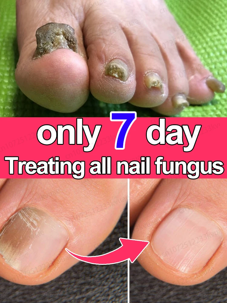 Nail Fungus Treatment Organic Essential Oil Repair Onychomycosis in 7 days