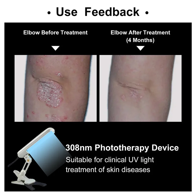UVB Lamp UV for Vitiligo Psoriasis White Spots Skin Disease 311nm Ultraviolet Phototherapy Instrument - Image 3