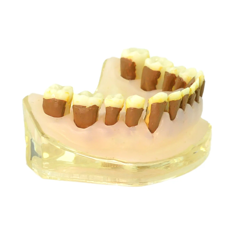 

Dental Periodontitis Teeth Model Dentist Teaching Model Periodontal Disease Model Dental Student Teaching Model