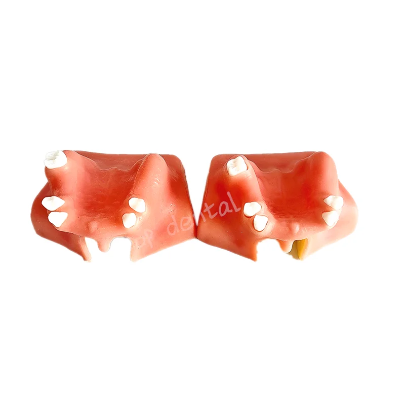 

2Pcs Dental Maxillary Teeth Model Upper Jaw Sinus Lift Implants Restoration For Medical Teach Study Demonstration