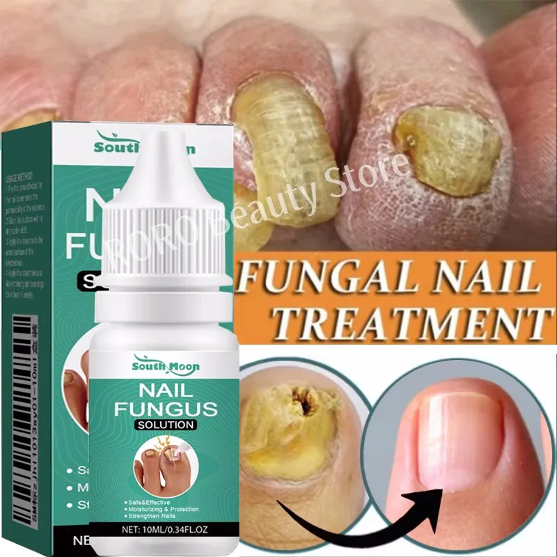Fungal Nail Treatment Essence Oil Nail Fungus Laser Device Repair Toenail Fingernail Ginger Treatment Hand Foot Essence Liquid