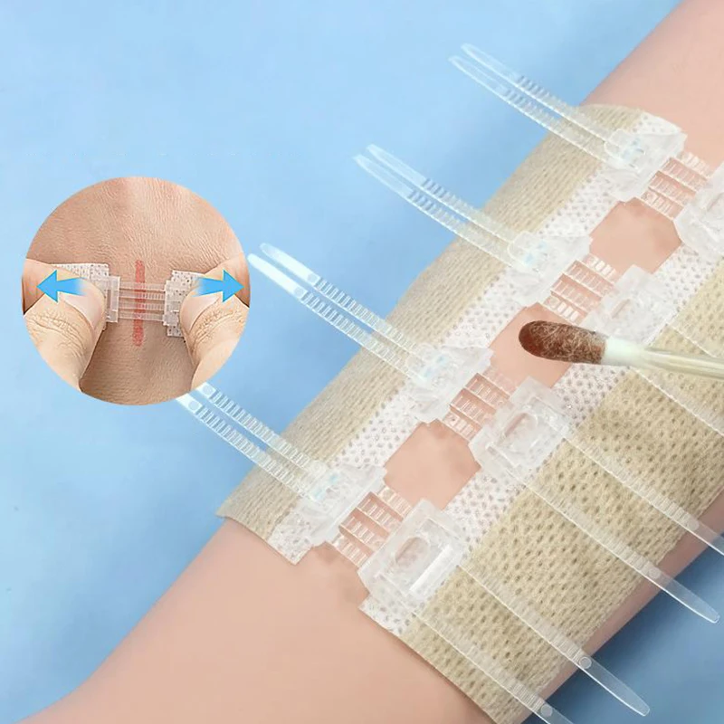 Portable Zipper Tie Wound Closure Patch Hemostatic Patch Wound Fast Without Suture