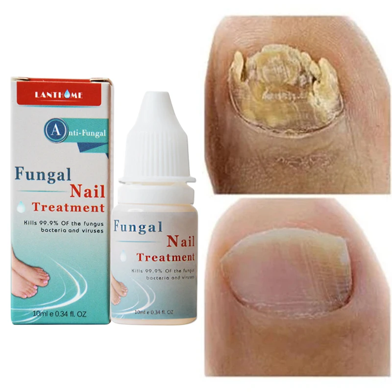 

Calcium Nail Fungus Treatment Nail Growth Serum Nails Feet Onychomycosis Remedy For Finger Nail Fungu Toenail Athlete's Foot10ml