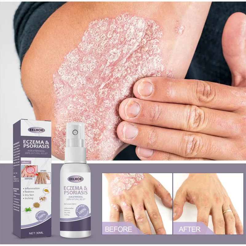 Antibacterial Psoriasis Spray Treatment Itching Eczema Rash Urticaria