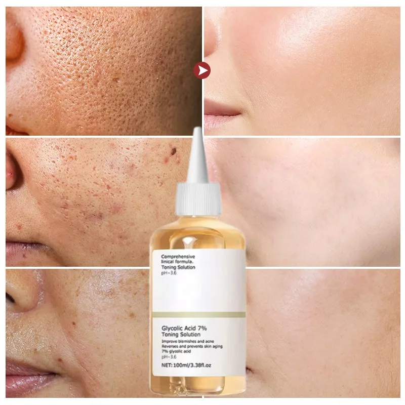 

Glycolic Acid 7% Acne Removal Serum Effective Acne Treatment Repair Spots Scar Moisturizing Oil Control Shrink Pore Skin Care