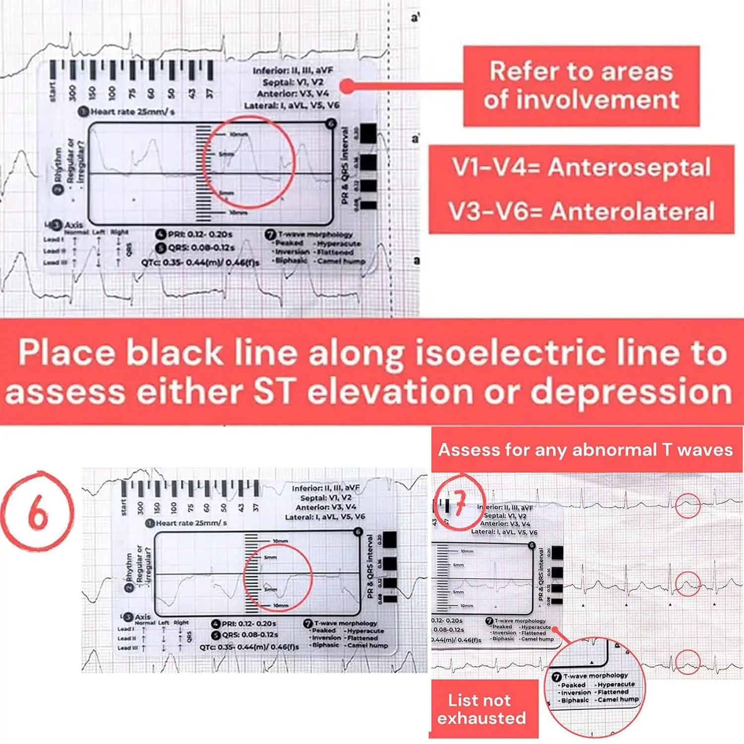 7 Step Ecg Ruler Plastic Ruler Card for Ecg/ekg Interpretation Portable Pocket Ecg Ekg Guide With Sheath Emergency Tool