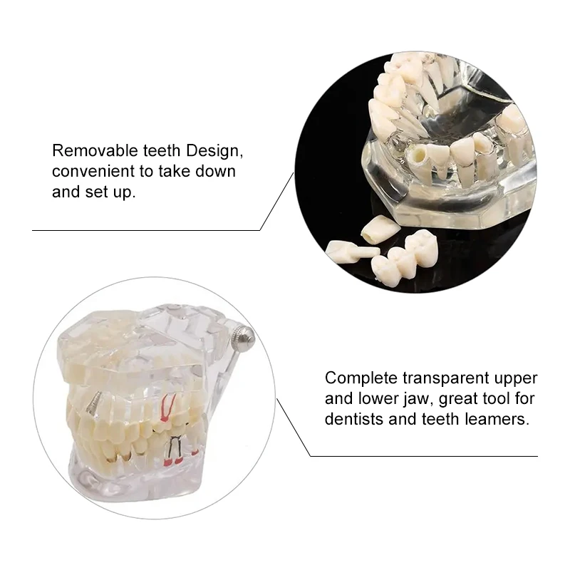 VVDental 치과 질환 치아 모형 치과 질환 교육용 연구 모형 의학용 수복 브릿지 치아 포함