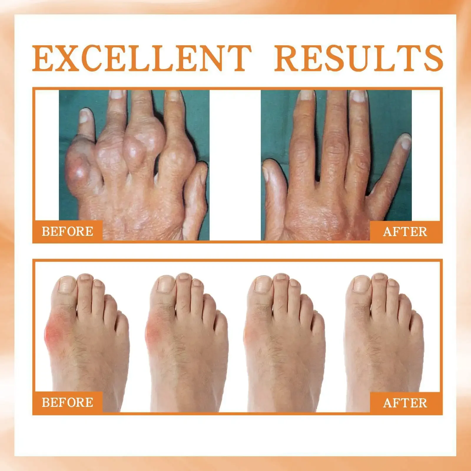 Pain Relief Cream Bee Venom Arthritis Spray Anti-Inflammatory Bone Therapy Muscle Ache Relief Treat Meniscus Sprain Medical Joint Analgesic Spray