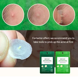Acne Pimple Patch Stickers Acne Treatment Pimple Remover Tool Skin Care 22 Patches Facial Mask Spot Waterproof Blemish