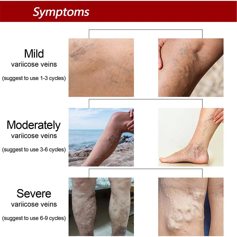 Varicose Veins Treatment Cream Relieve Legs Tired Dilated Vasculitis Phlebitis Spider Pain Relief Ointment Medical Body Plaster