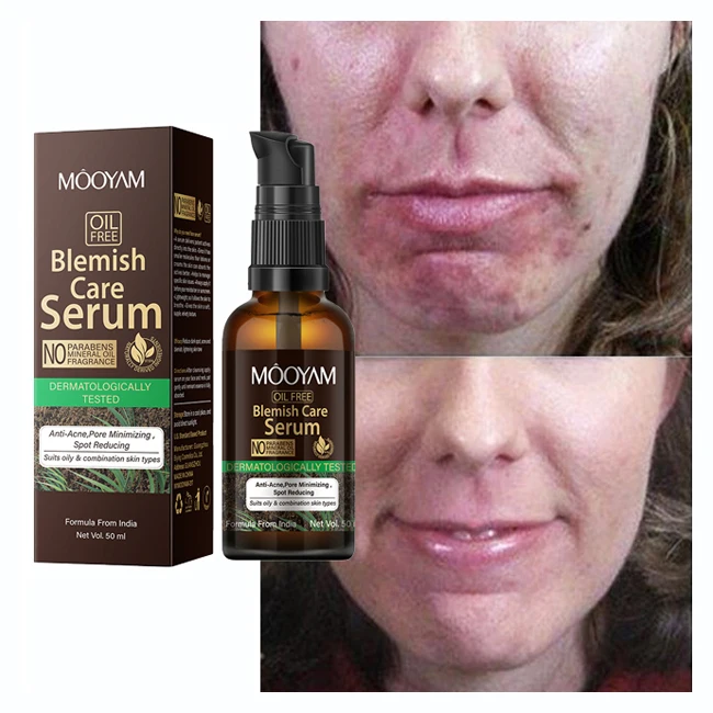 Acne Redness Dark Spots Scars Serum Skin care Spot Clearing Blemish Care Serum