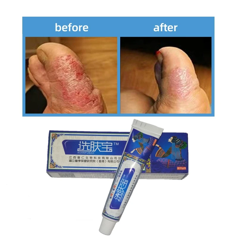 Antibacterial Psoriasis Cream Herbal Effective Anti-itch Relief Dermatitis Eczema Treatment Urticaria Desquamation Skin Care