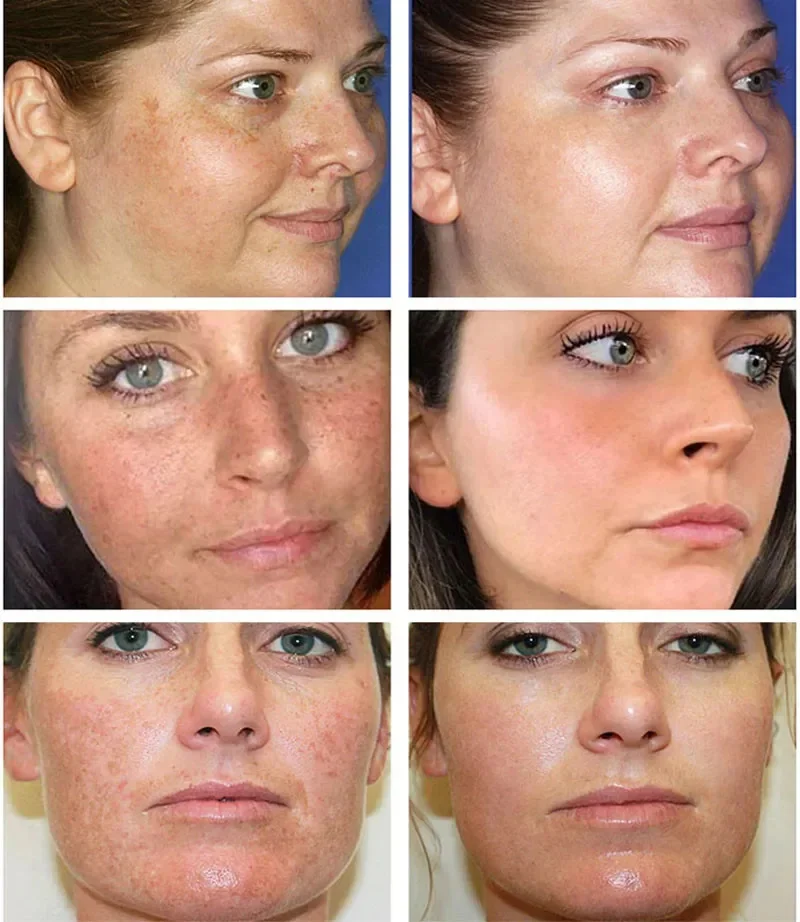 Dark Spots Remover Whitening Facial Serum Face Freckle Melanin Correcting Anti Pigmentation Brighten Skin Care