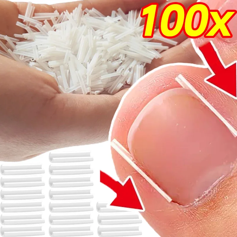 Ingrown Toenail Correction Tool Plastic Foot Care
