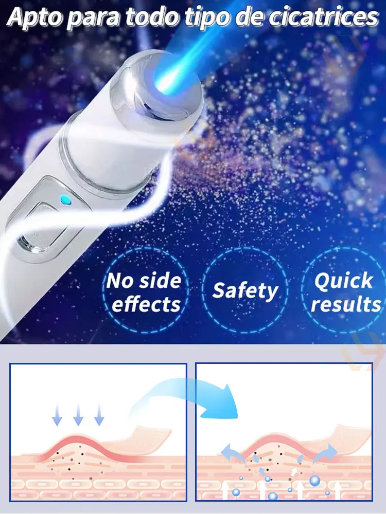 2세대 레이저 펜: 흉터를 지우고 건강한 피부로 회복하세요