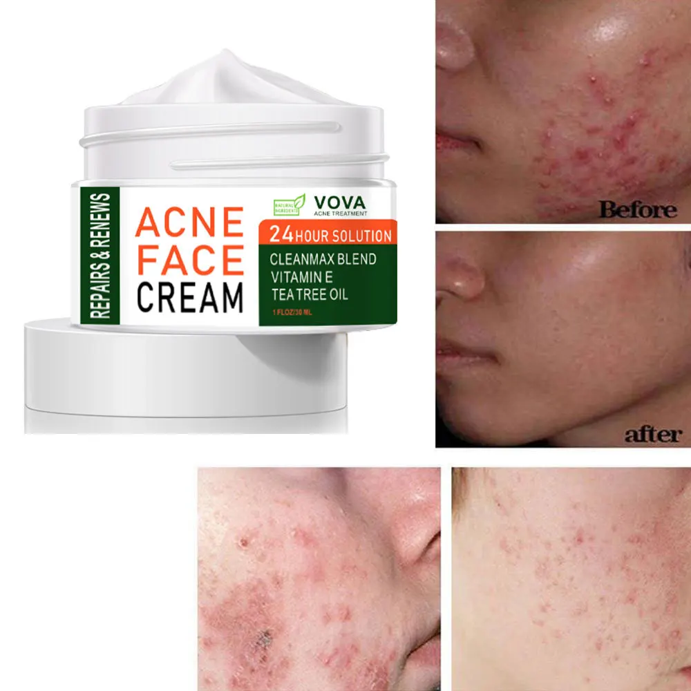 Efective Acne Removal Cream Oil Control Aloe Spots Treatment Pores
