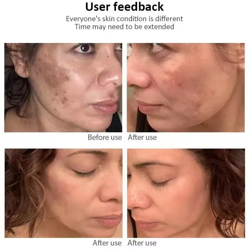 Fades Freckle Dark Spots Face Cream Niacinamide Whitening Cream Vitamin E Improve Dullness Fast Brighten Nourish Skin Care whitening body cream niacinamide serum facial cream