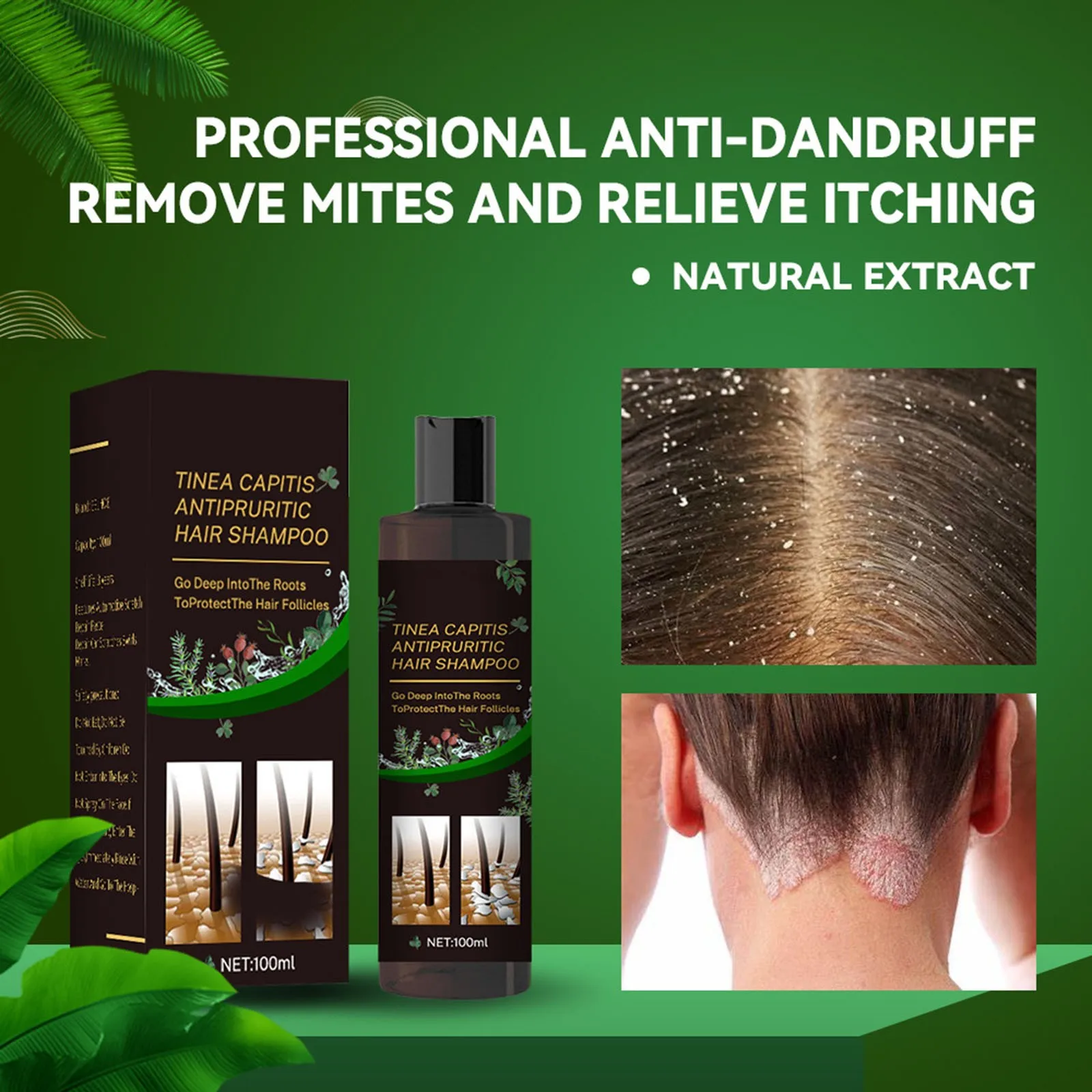 Hair Shampoo For Tinea Capitis Antipuriticprofessional Antidandruff Remove Mites Andrelieve Itching Shampoo 100ml Party Favours