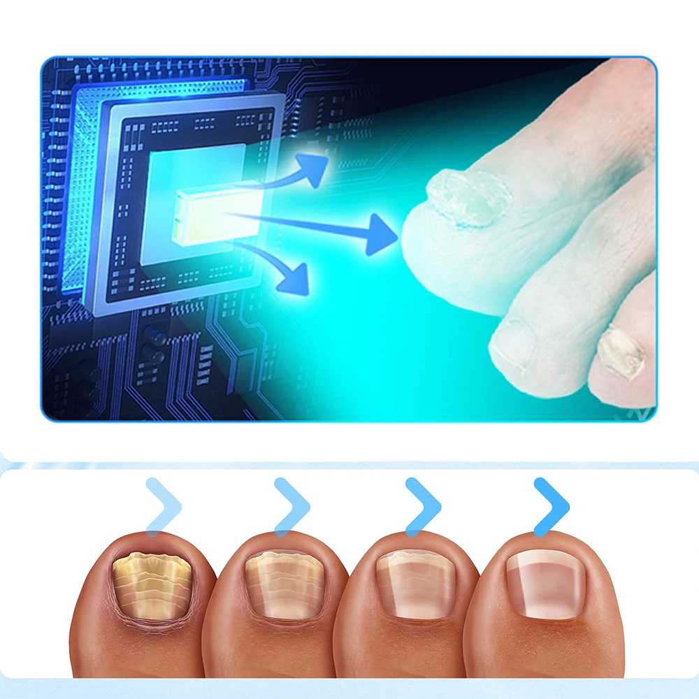 Nail Laser Fungus Device 680NM Red light Killing Fungi + 470nm Blue Light Antiphsis All-inclusive Nail Fungus Treatment 20W nail fungus remover