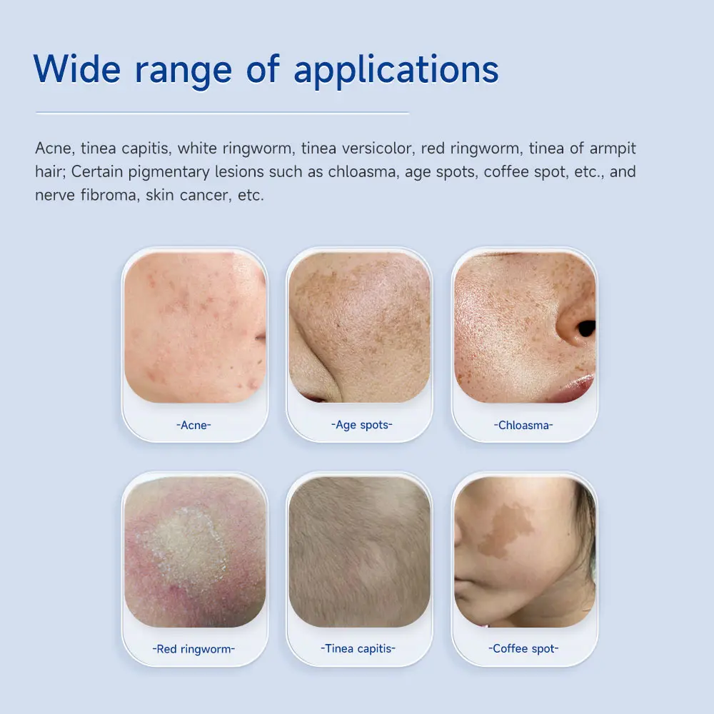 Skin Tinea Versicolor Woods Lamp Exam