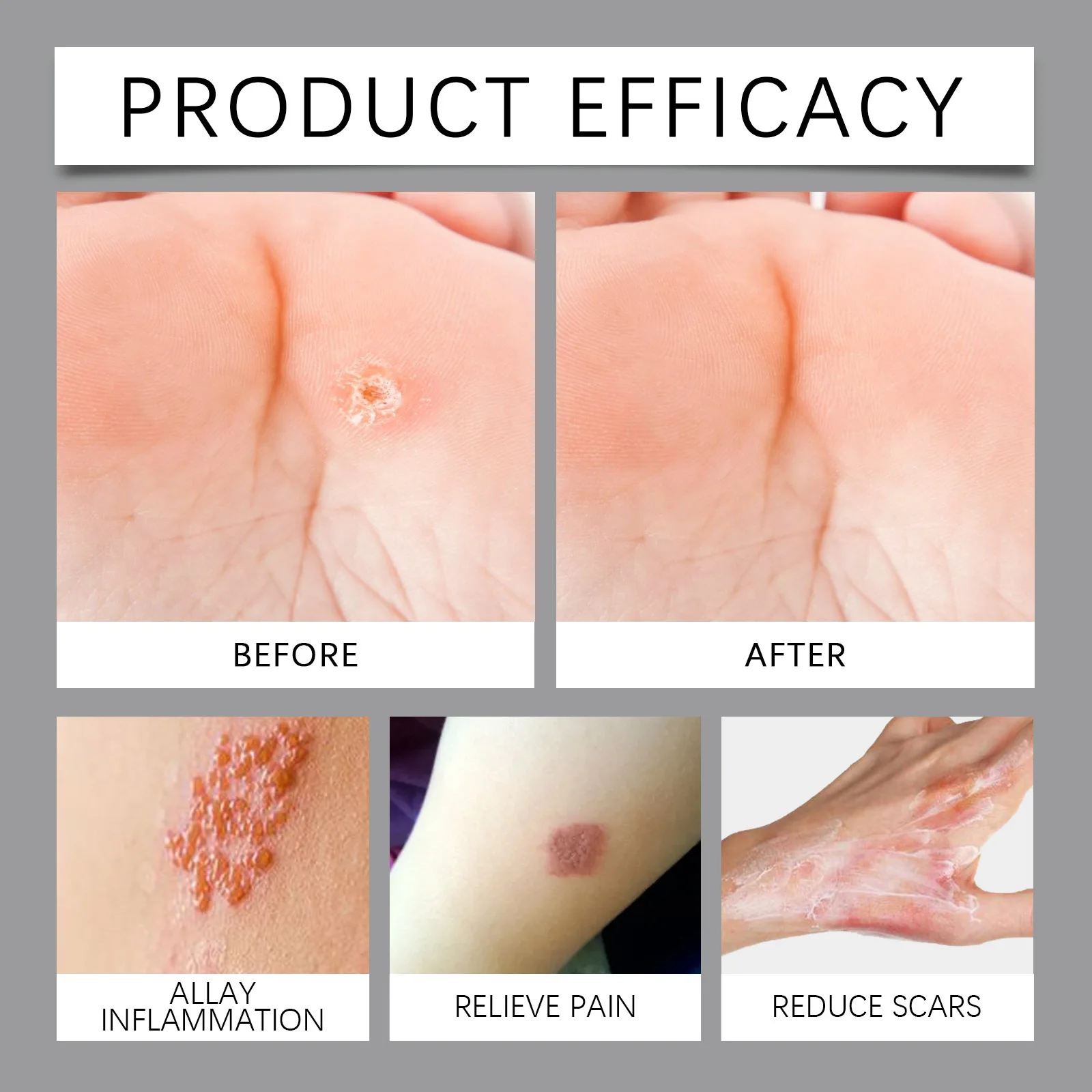 South Moon Bedsores Wound Healing Ointment Removal Rot Myogenic Pressure Sores Ulcer Festering Anti Infection Repair Skin Care