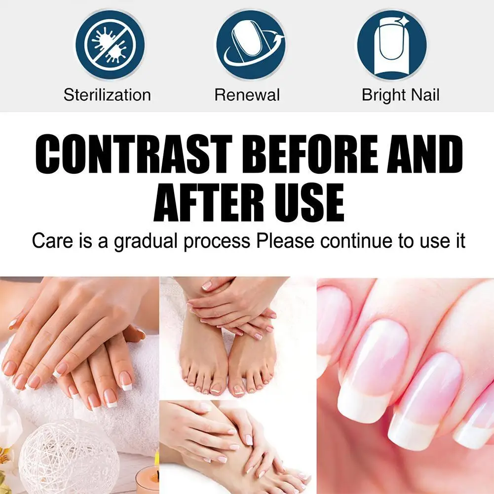 Nail fungus remover 3ml nail treatment solution reusable