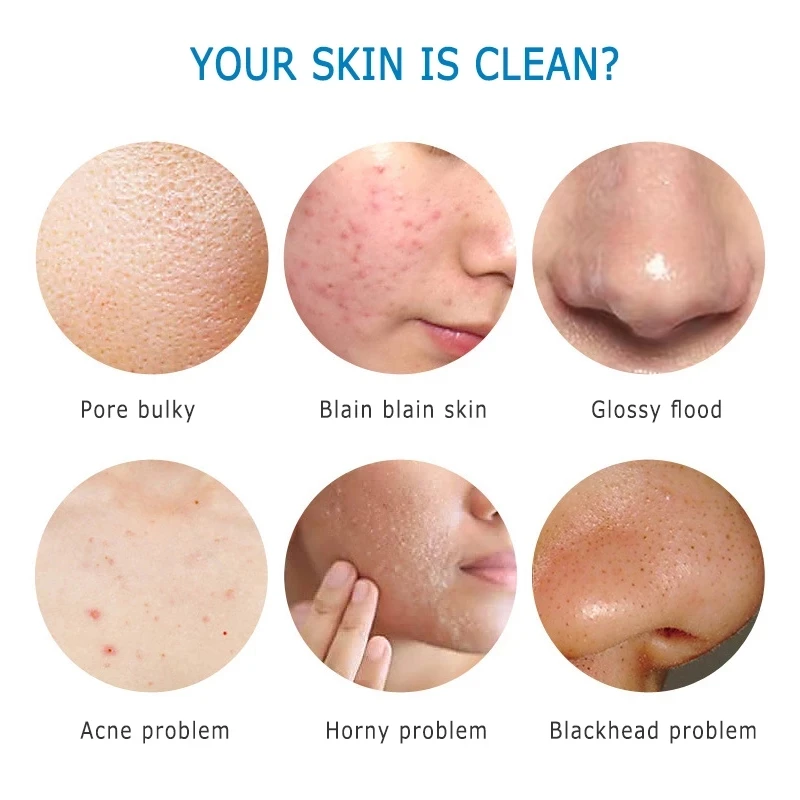 acne tratamento ácaro remoção sabão rosto cuidados