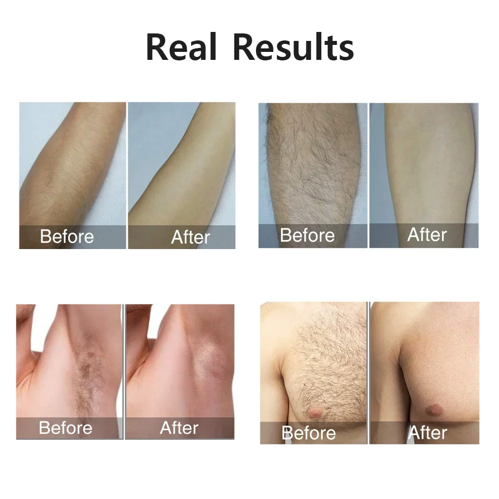 Portable IPL Laser Epilator 999999 Flashes-Painless, Permanent Hair Removal for Women&rsquo;s Body and Bikini Line Wax Roll on wax