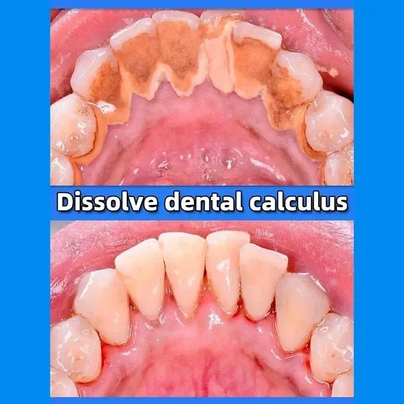 Dental Calculus Remover Whitening Bad Breath Teeth Toothpaste Brightening Preventing Periodontitis