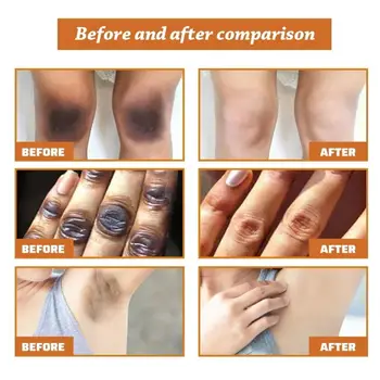 Yellow Peeling Oil Bleach Dark Skin Whiten Lotion Lighten Body Elbow Knee 21