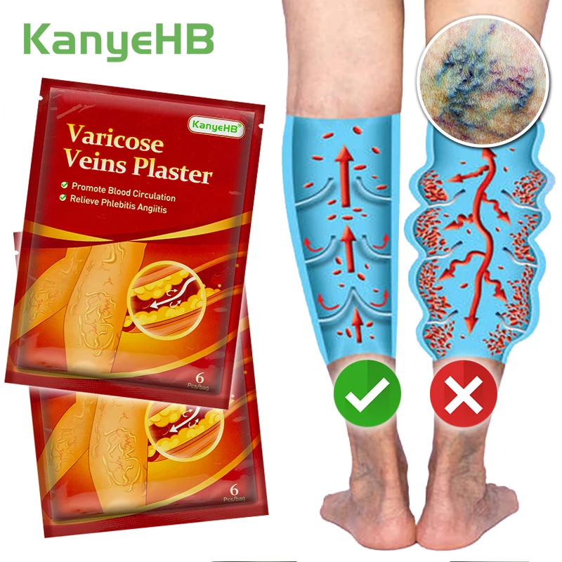 

12pcs=2bags Varicose Vein Plaster Varicosity Patch Anti-swelling Vein Pain Relief Patch Vasculitis Phlebitis Herbal Sticker A593