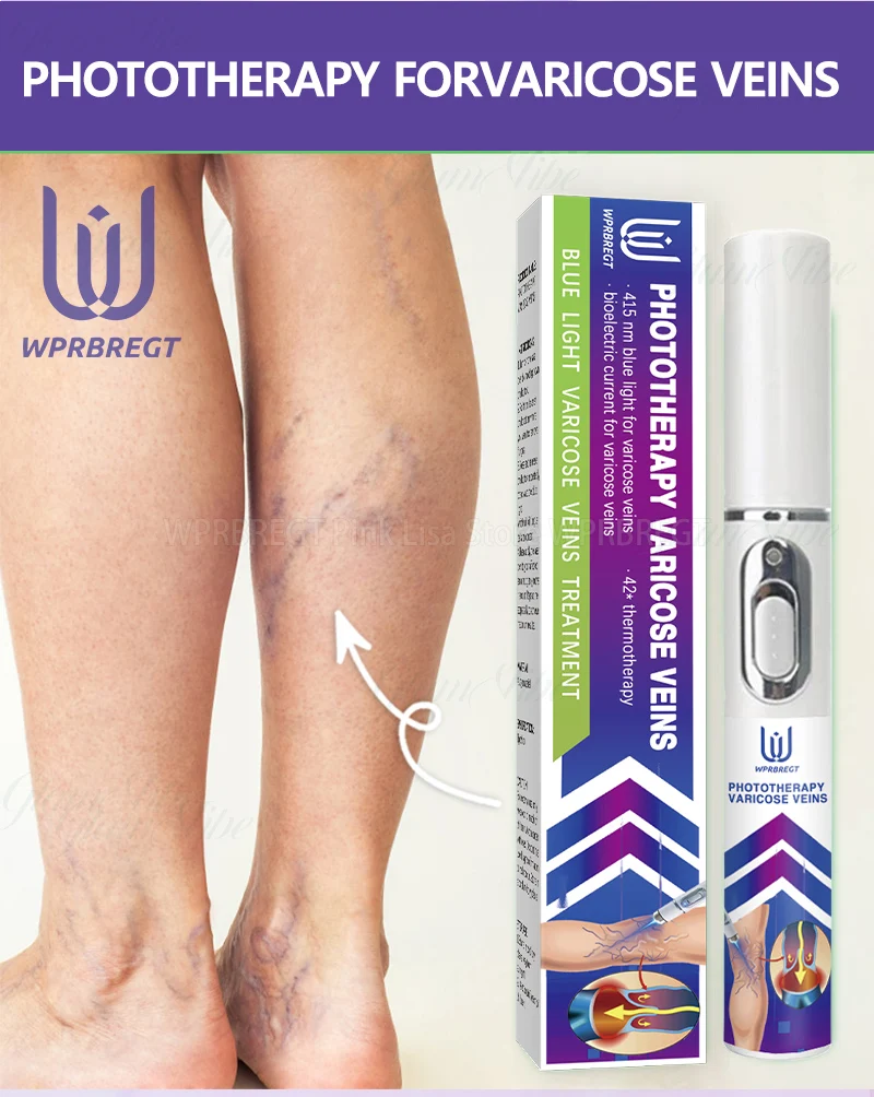 2nd generation varicose vein laser eliminates vasculitis and phlebitis, relieves spider leg pain, laser pointer for treatment