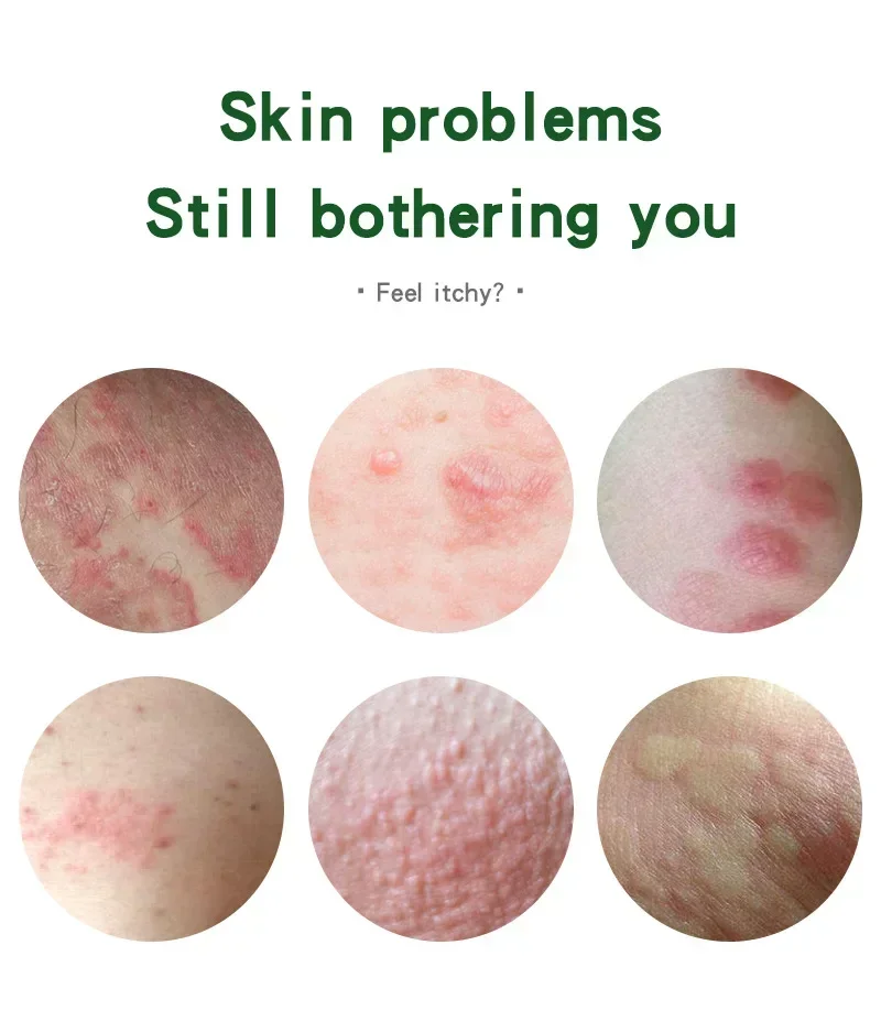 15g Skin Ringworm King Cream Antibacterial Ointment Relieving Itching King Rotten Foot Athlete's Foot Cream Beauty Health Care