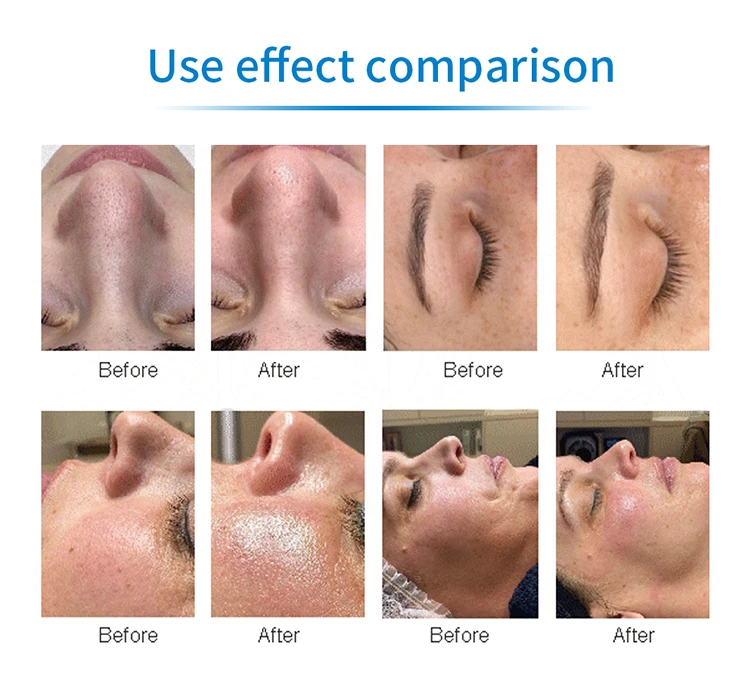 Hydrafacial Diamond Skin Machine – Öregedésgátló arcápolás hidratáló spray-vel és mélytisztítással