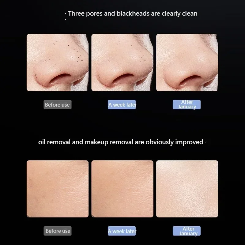 Blackhead Remover Blackhead Cleaning Pore Shrinking Beauty Device Dead Skin Acne Scalper Facial Pore Cleanser Beauty Equipment
