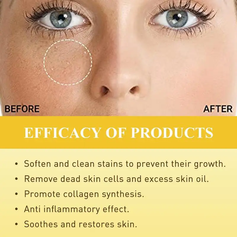 Sebaceous Cyst On Eyelid lupon.gov.ph