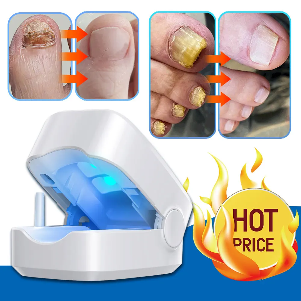 incley Appareil laser de nettoyage des champignons des ongles, appareil de  traitement laser pour ongles d'orteils et onychomycose, thérapie efficace  des ongles à la lumière bleue, dissolvant efficace de champignon des ongles