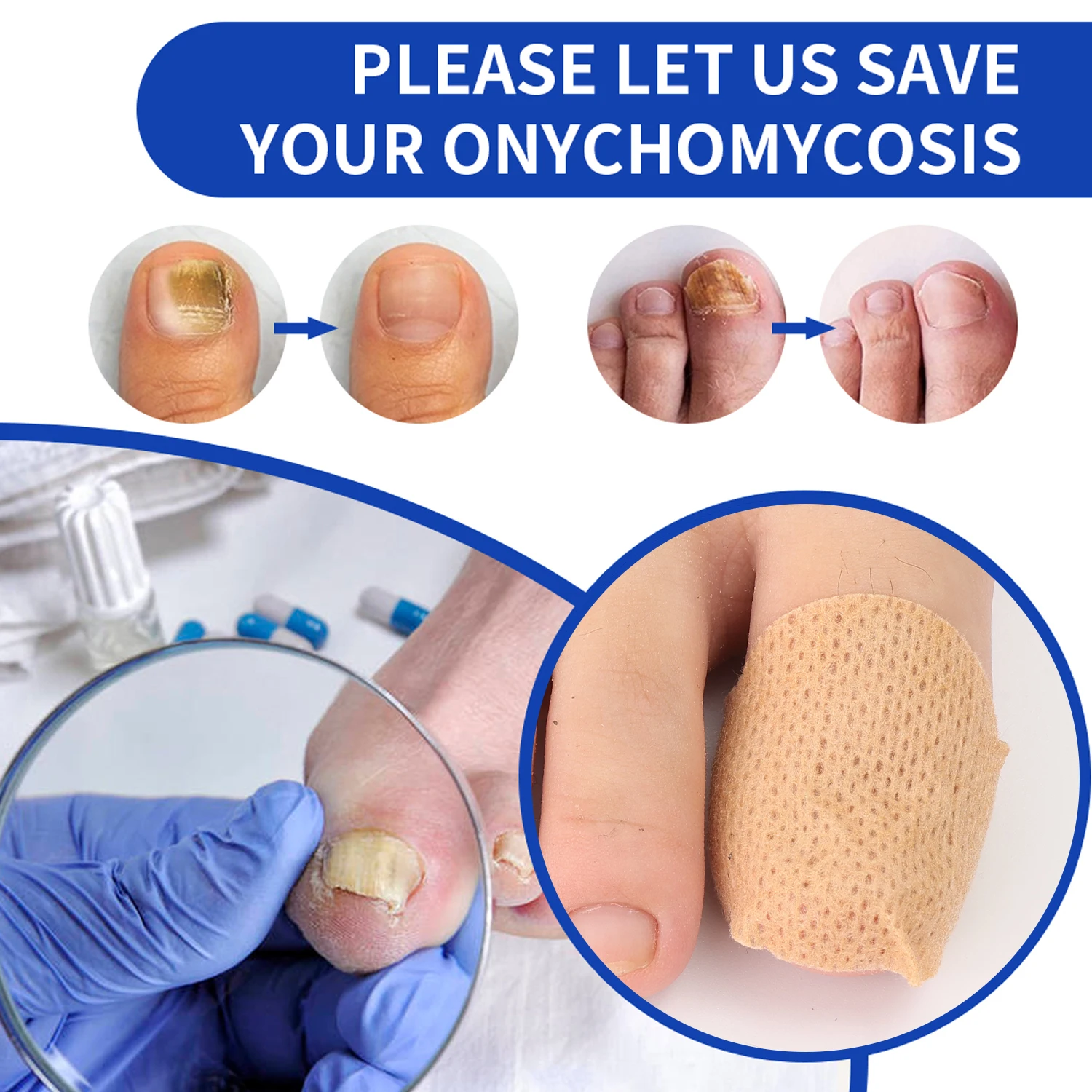 Ingrown Toenail Correction Patch Waterproof Nail Repair Tool Set_voghion.com