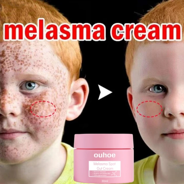 Powerful Whitening Freckle Cream removes dark spots and brightens dull skin