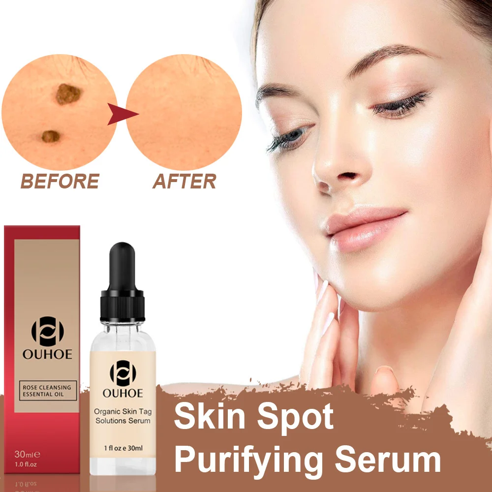 OUHOE Nevus Eliminating Lotion Nevus Eliminating Lotion Crema Riparatrice e Rimozione di Macchie Nere Nevus Eliminating Rose_voghion.com
