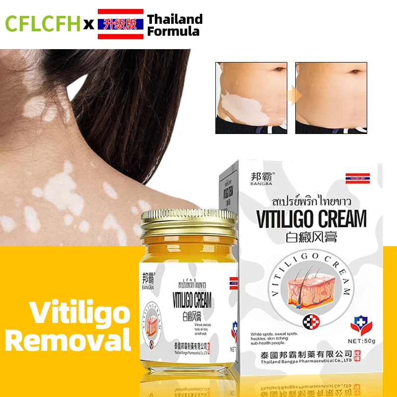 

50G Vitiligo Skin Treatment Cream White Spot Remover Promote Melanin Repair Leg Leukoplakia Removal Thailand Medicine