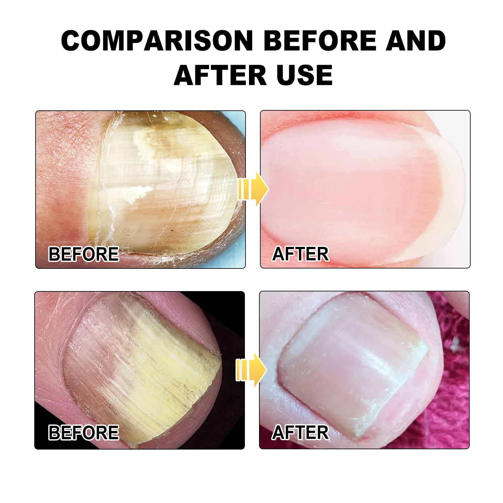 Fungal Nail Laser Treatment Device for Toenail