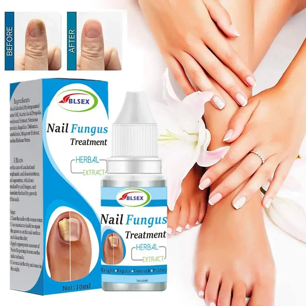 U&ntilde;as Fungus Nails Treatment for Fingernails Toenails Repair Onychomycosis Paronychia Anti Infection Toe Nail Fungal Removal