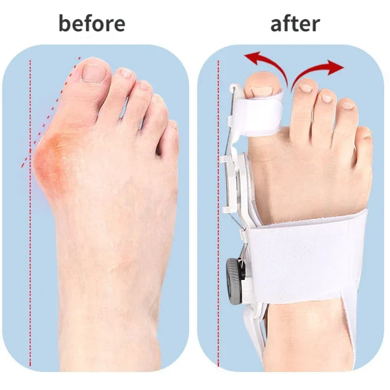 Bunion Corrector Unisex Foot Hallux Valgus Braces Rotatable Toe Separator Straightener Adjustable Pedicure Finger Toe Corrector