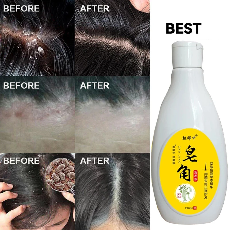 210ml Scalp Cleansing Shampoo Dandruff Seborrheic Follicles