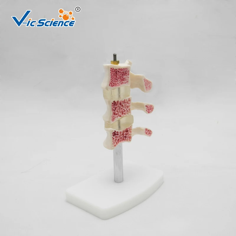 Life Szie Anatomical Human Cutaway Osteoporosis