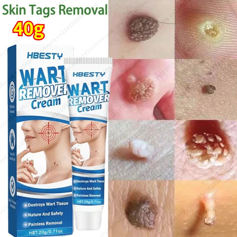 

Skin Tag Remover Genital Wart Treatment Instant Removal Mole Papillomas Foot Corn Repair Tool Natural Bacteriostatic Cream