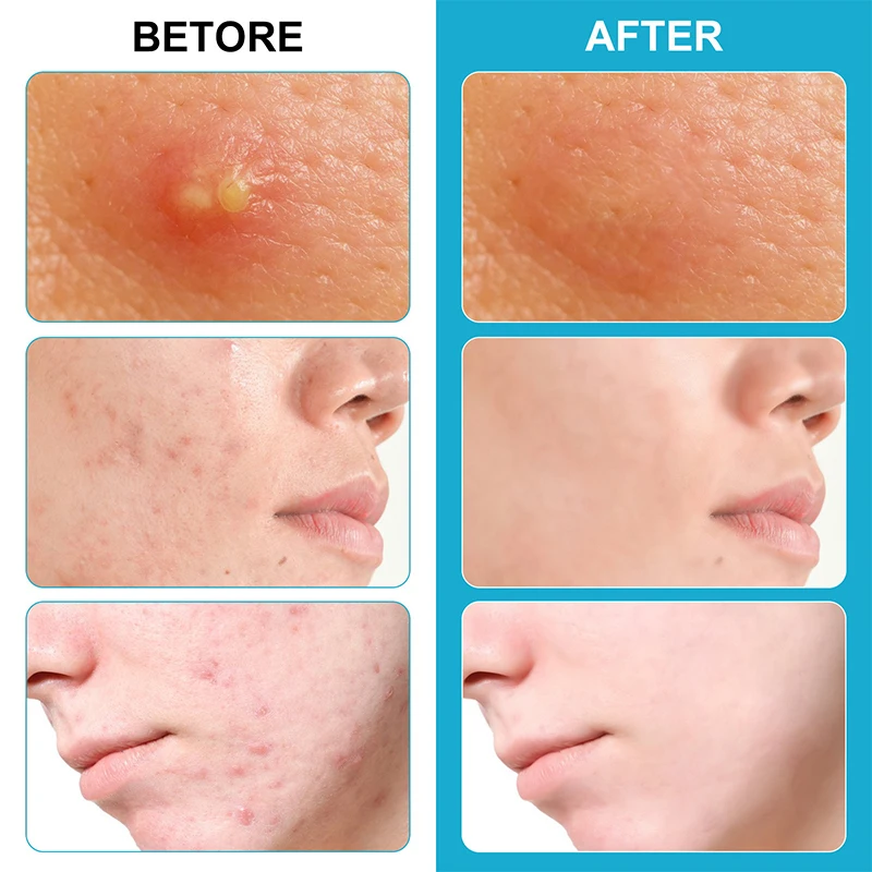 Face Patches For Pimples Microneedles Drying Patch Blemish Covering Stickers 6 Count Invisible Spot Care Absorbing All Day
