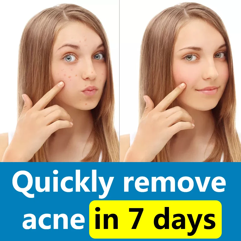 Fast Acne Cream with Moisturizing Hyaluronic Acid Pore Cleansing Oil Control Acne Marks Firming Skin Getting Ridance of Stubborn